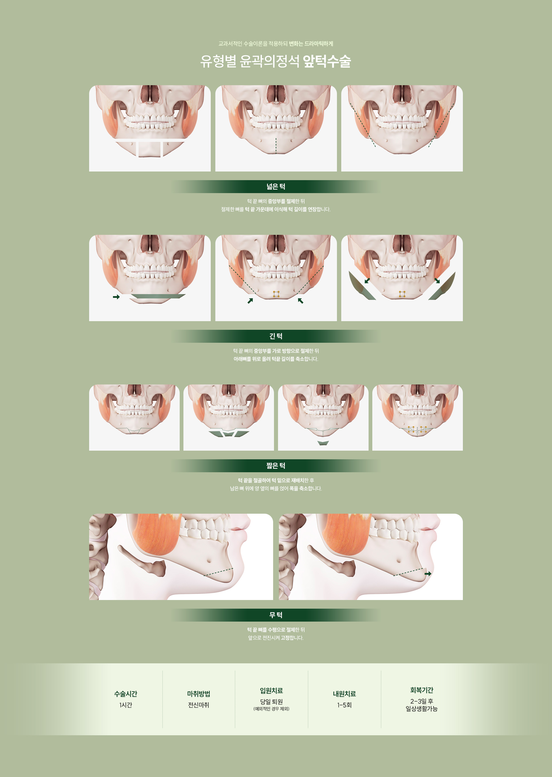 앞턱수술 02